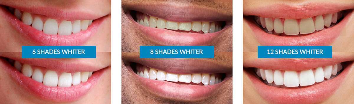 Teeth Whitening Casta o Periodontics Dental Implants